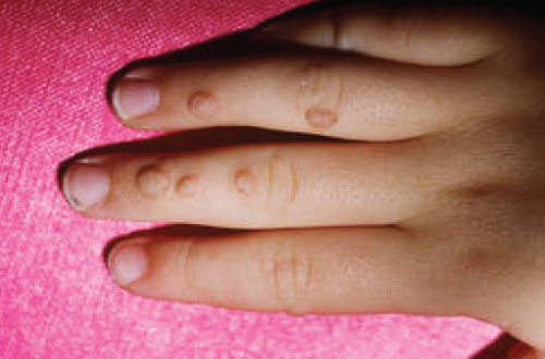 Mụn cóc xuất hiện trên ngón tay của bé