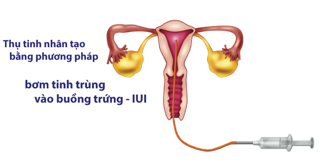 Tìm hiểu phương pháp bơm tinh trùng vào buồng tử cung – IUI