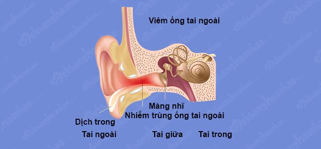 Viêm ống tai ngoài ở trẻ em