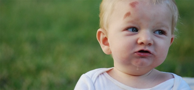 Các vết bớt ở trẻ sơ sinh thường gặp