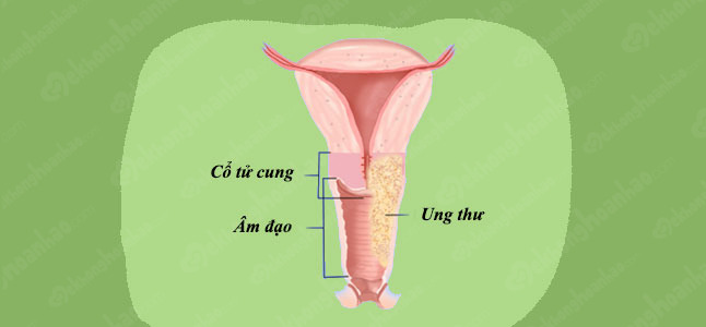 Các giai đoạn ung thư cổ tử cung, bạn nên biết!