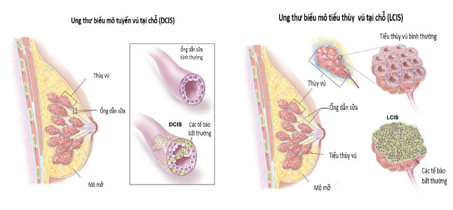 Tìm hiểu các giai đoạn ung thư vú