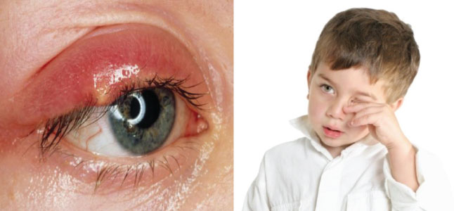 Cách chữa lẹo mắt ở trẻ em